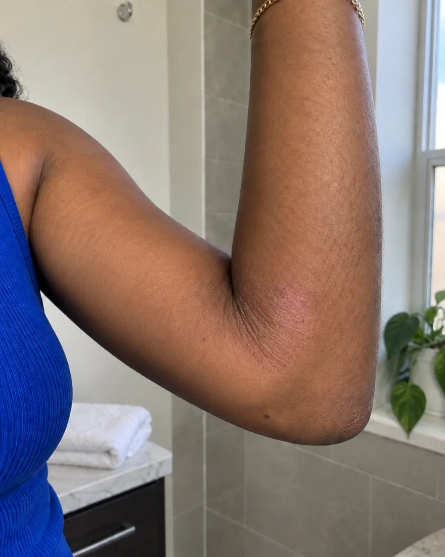 The same elbow, with the patch smooth