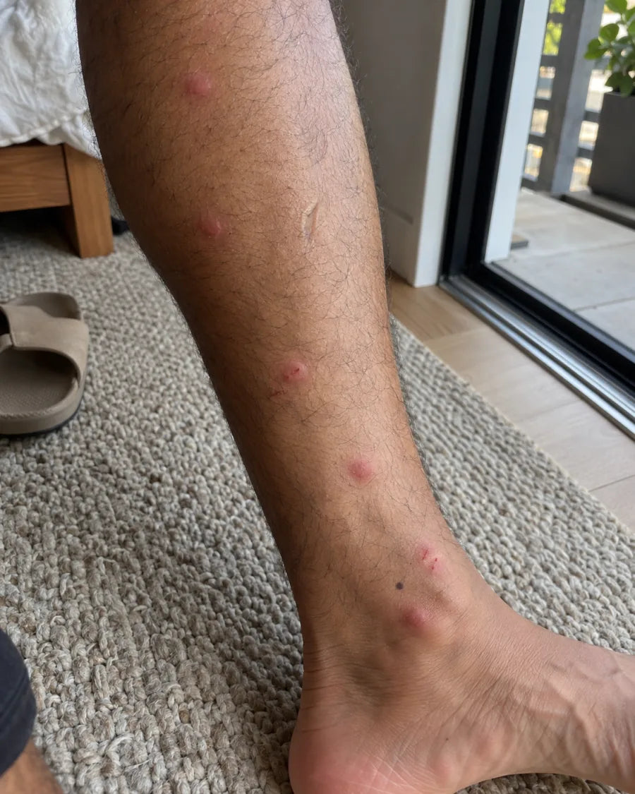 A lower leg with several raised bites