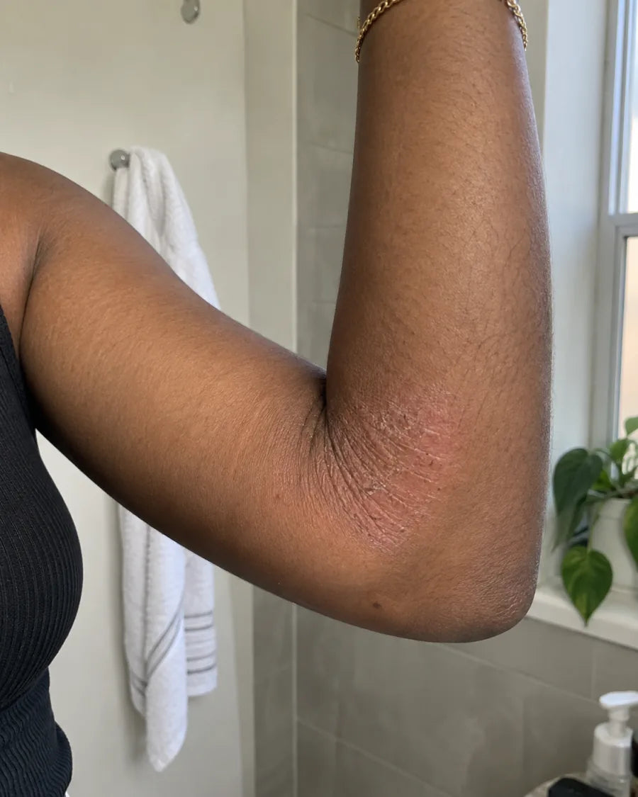 An elbow with a dry flaking patch of skin