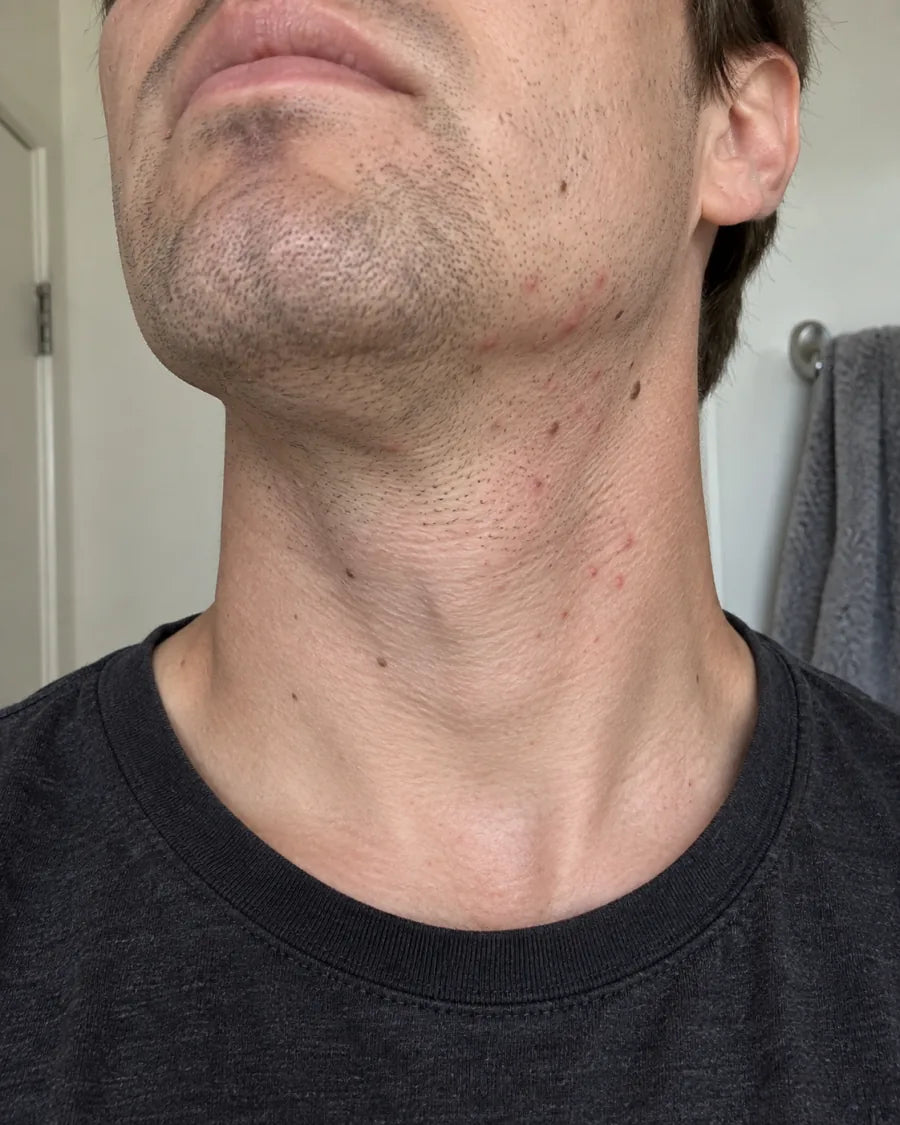 A jaw and neck after shaving, with small red bumps along the neck