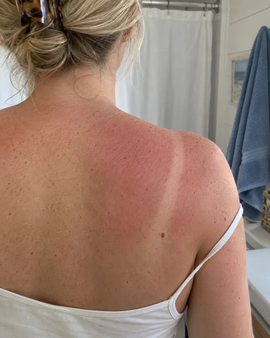 A shoulder and upper back reddened by sun, with a pale strap line